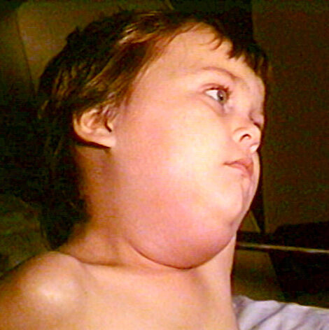 Caxumba: Mumps PHIL 130 lores.jpg