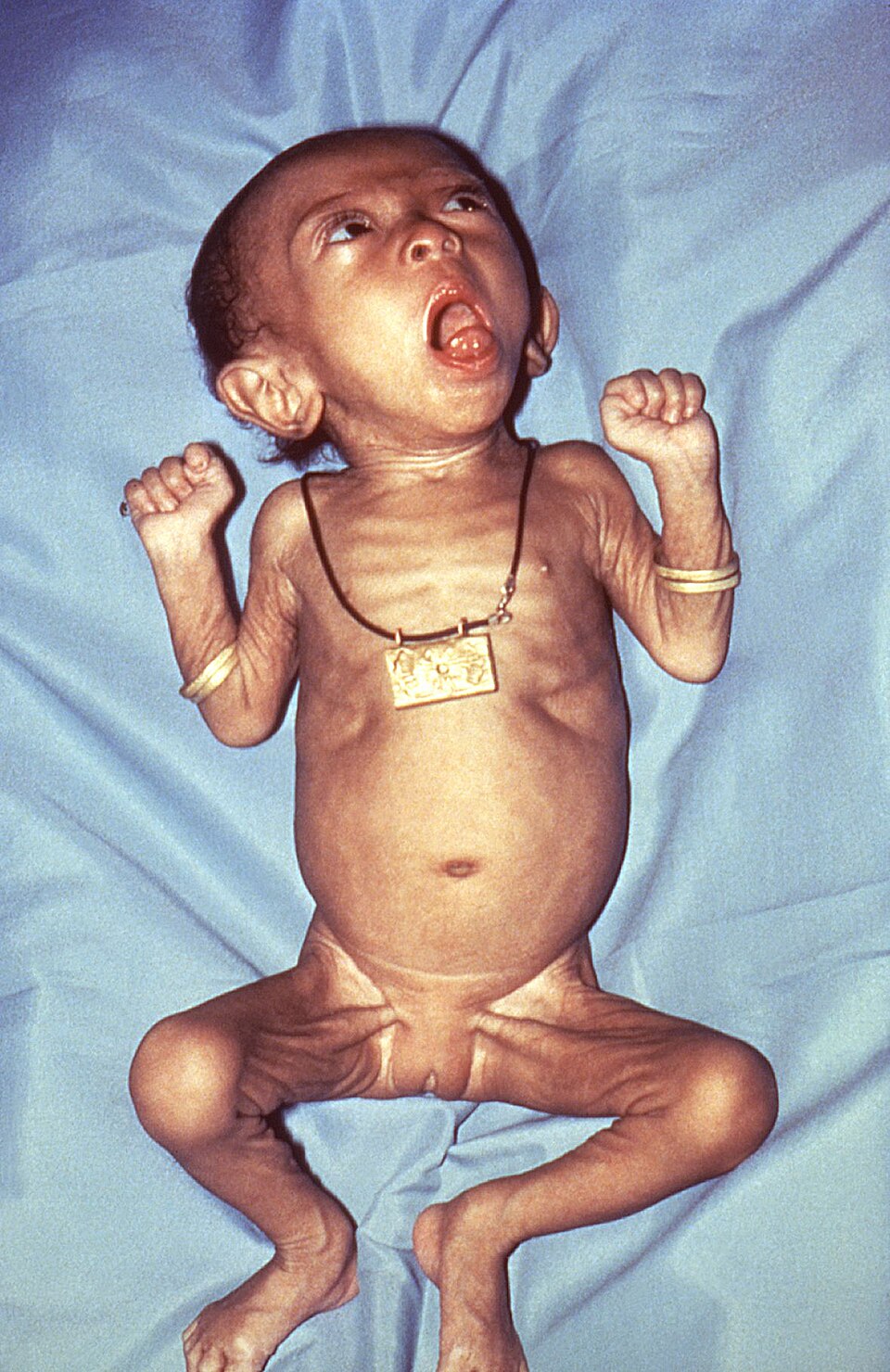 Coqueluche: Bordetella pertussis 6379 lores.jpg