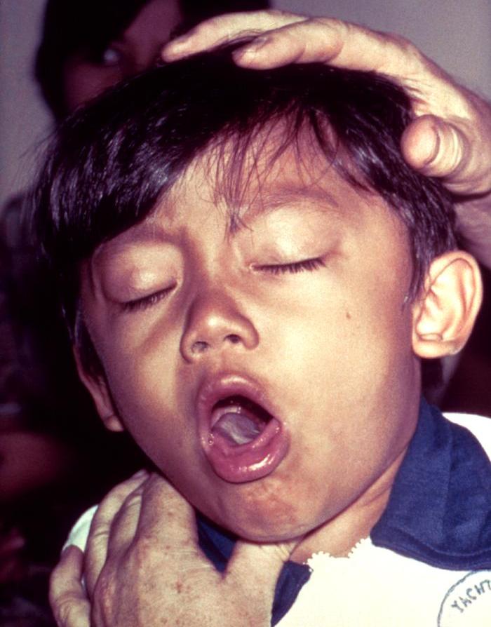 Coqueluche: Pertussis.jpg