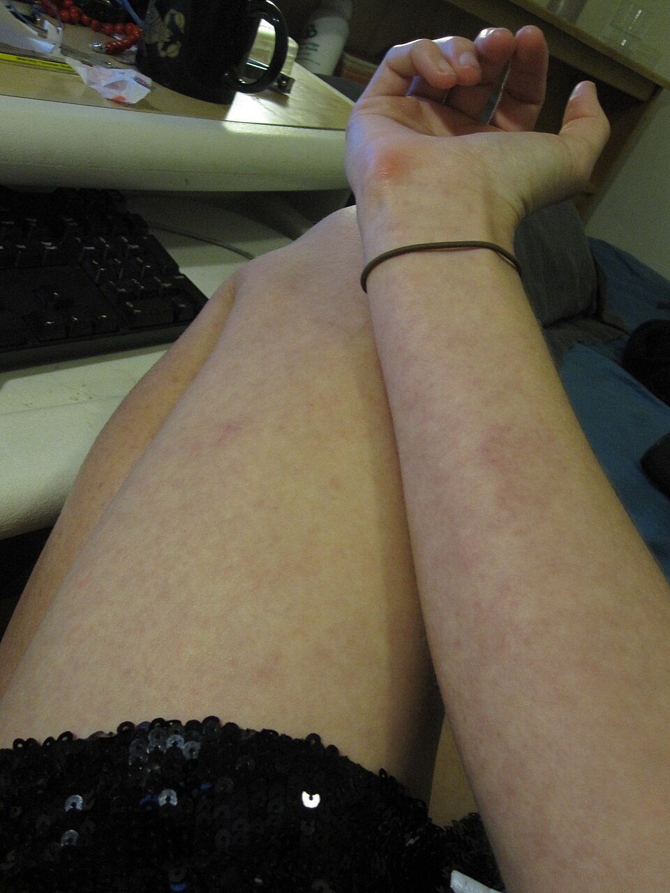 Dengue: Dengue rash.jpg
