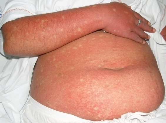 Dengue: Erythema with petechiae on patient with dengue fever.jpg
