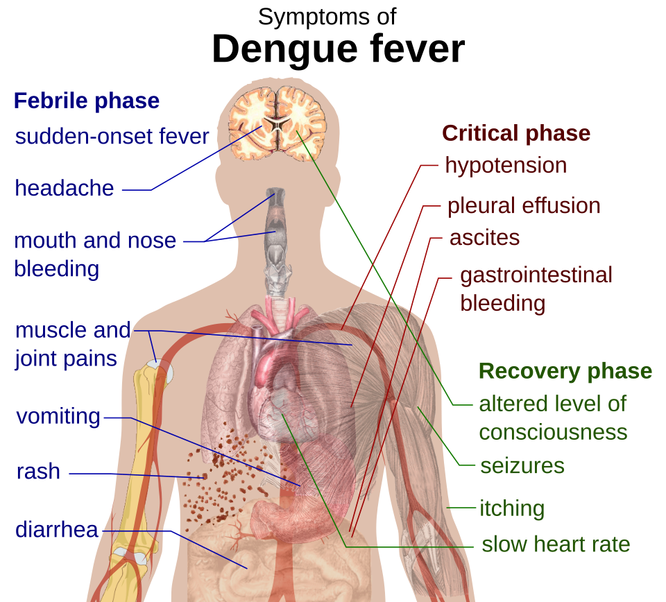 Dengue: Dengue fever symptoms.svg