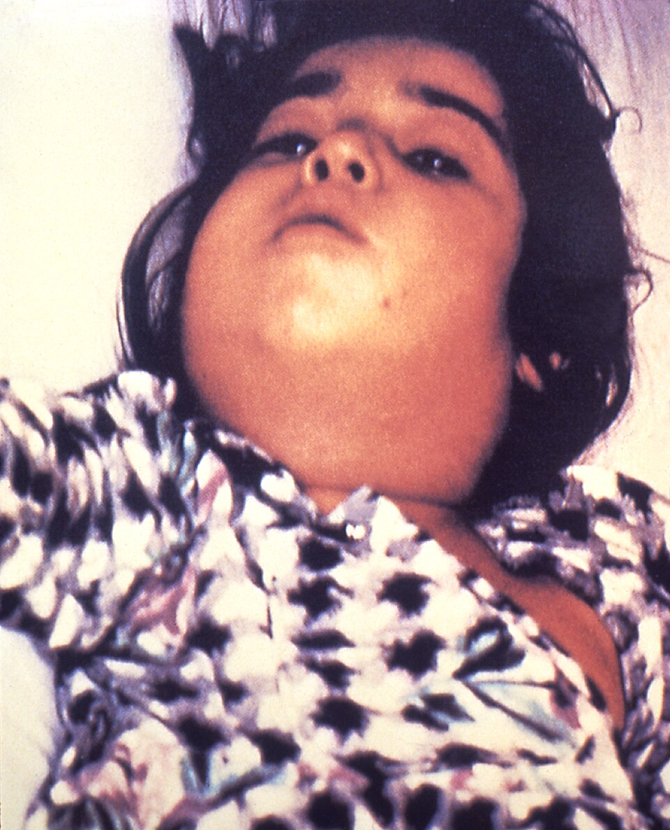 Difteria: Diphtheria bull neck.5325 lores.jpg