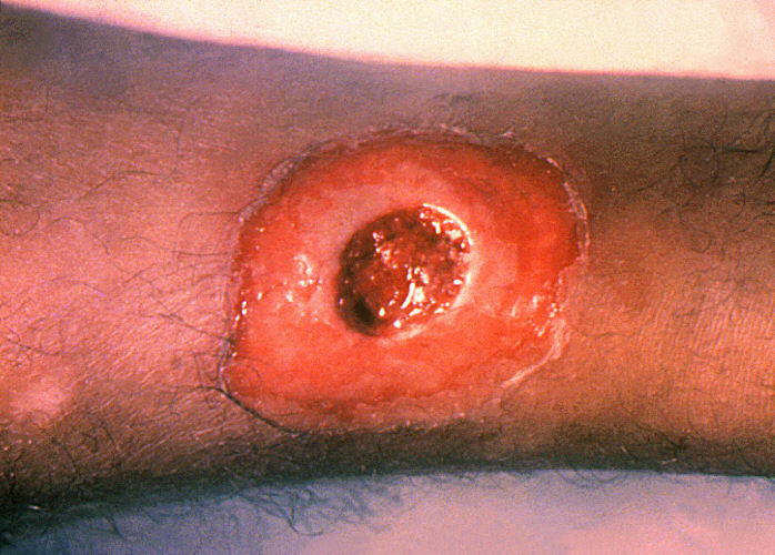 Difteria: A diphtheria skin lesion on the leg. PHIL 1941 lores.jpg