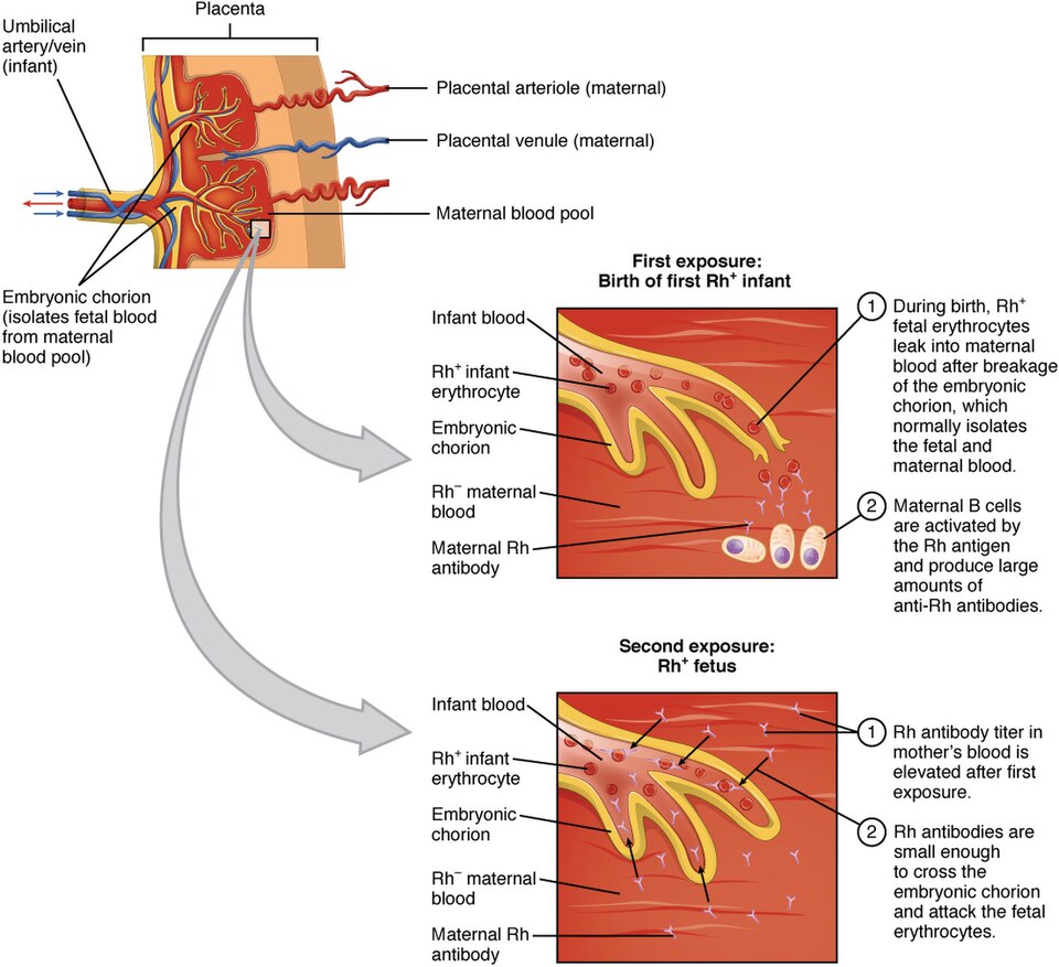 Doença Hemolítica do Recém-Nascido: 2230 Erythroblastosis Fetalis.jpg