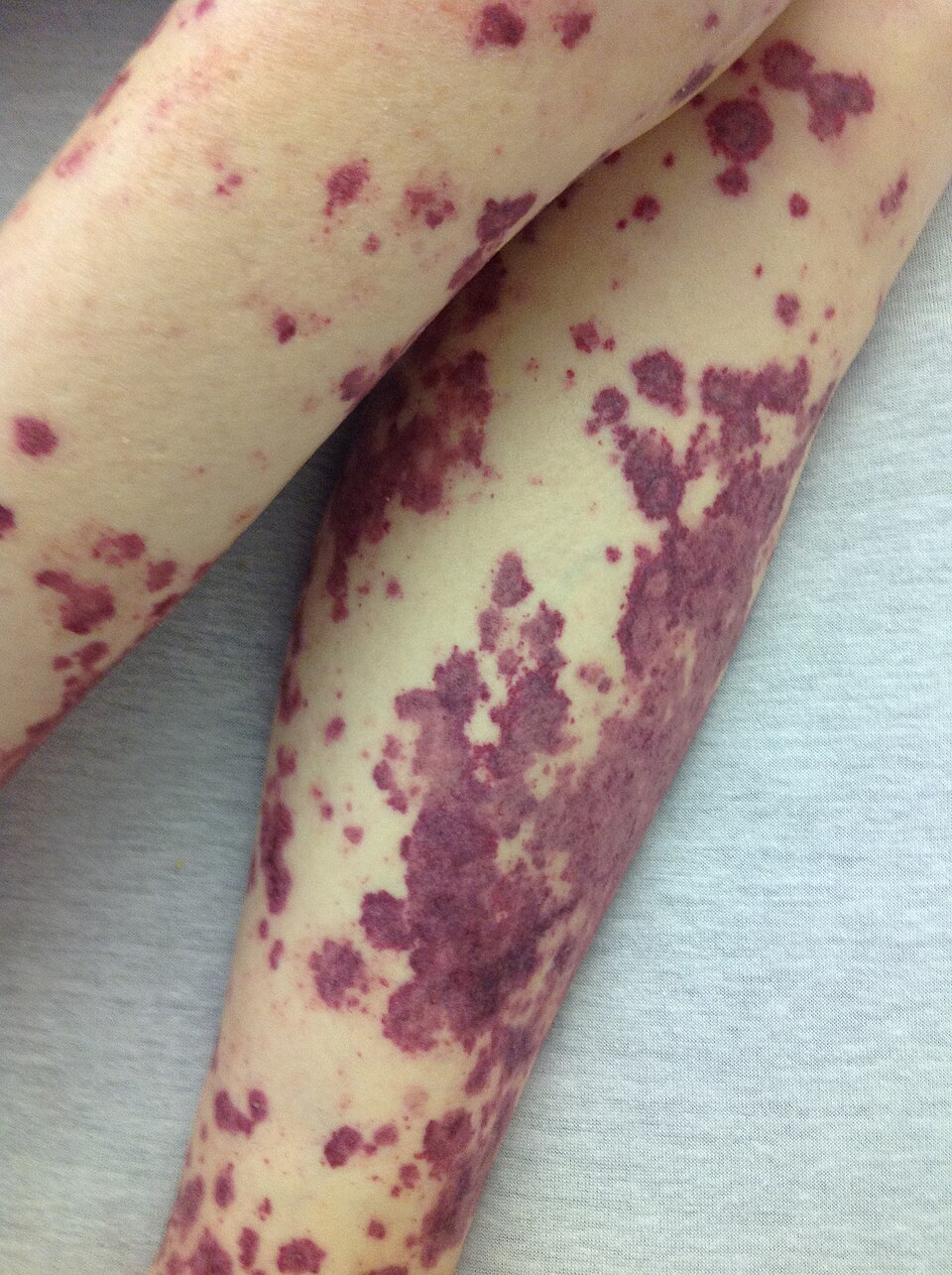 Doença Meningocócica: Petechial rash.JPG