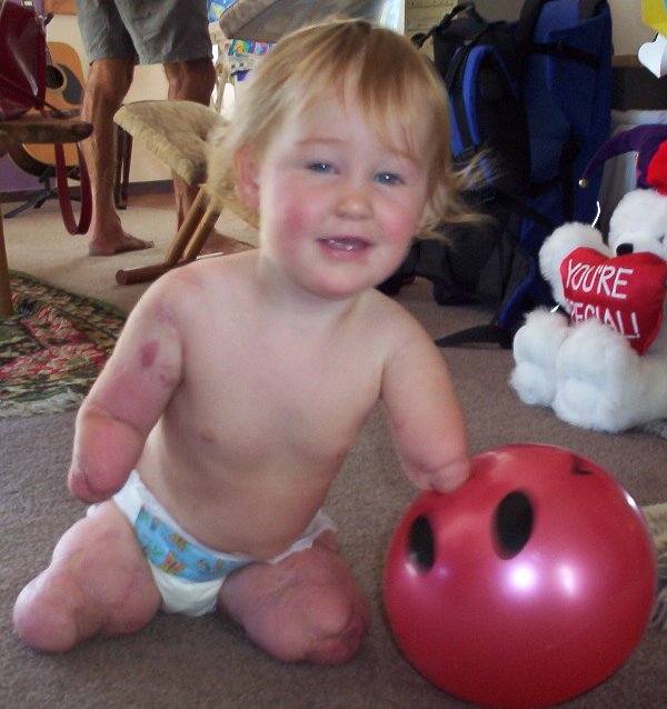 Doença Meningocócica: Charlotte Cleverley-Bisman.jpg