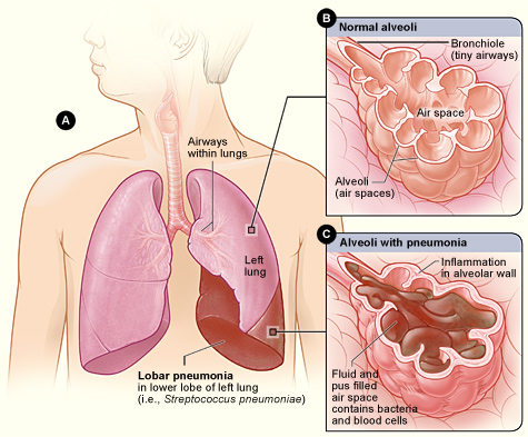 Doença Pneumocócica: Lobar pneumonia illustrated.jpg