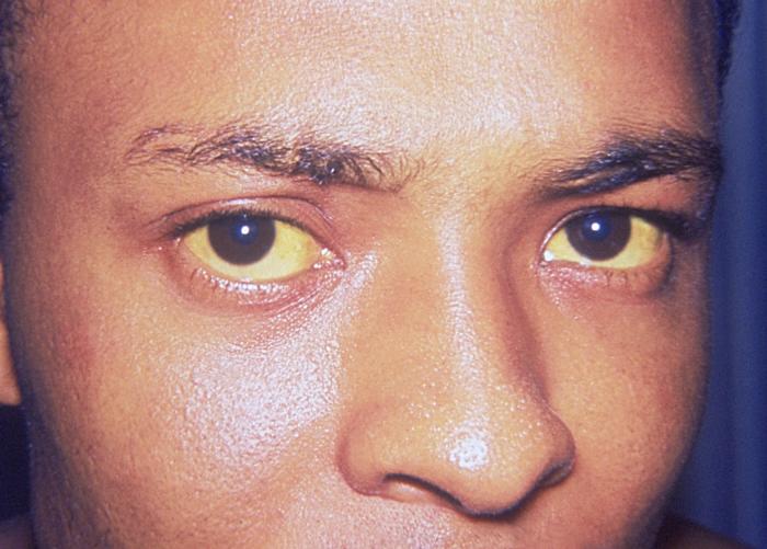 Hepatite A: Jaundice eye.jpg