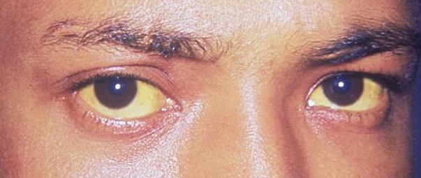 Hepatite B: Jaundice eye new.jpg