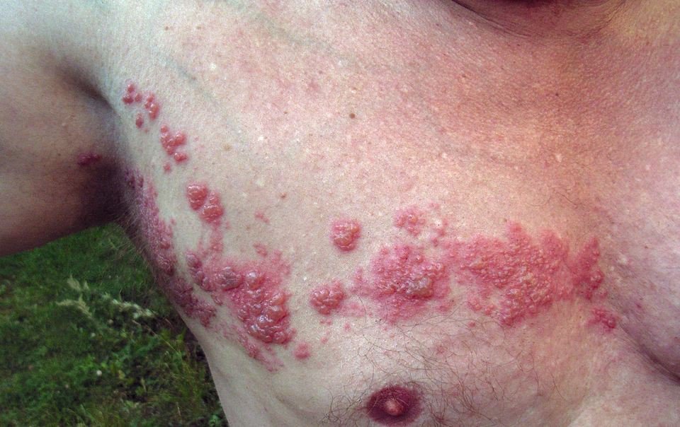 Herpes-Zóster (Cobreiro): Herpes zoster chest.png