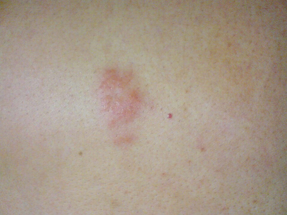 Herpes-Zóster (Cobreiro): Herpes zoster back.jpg