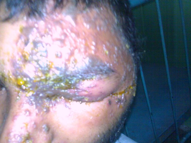 Herpes-Zóster (Cobreiro): Herpes Zoster of the face.jpg