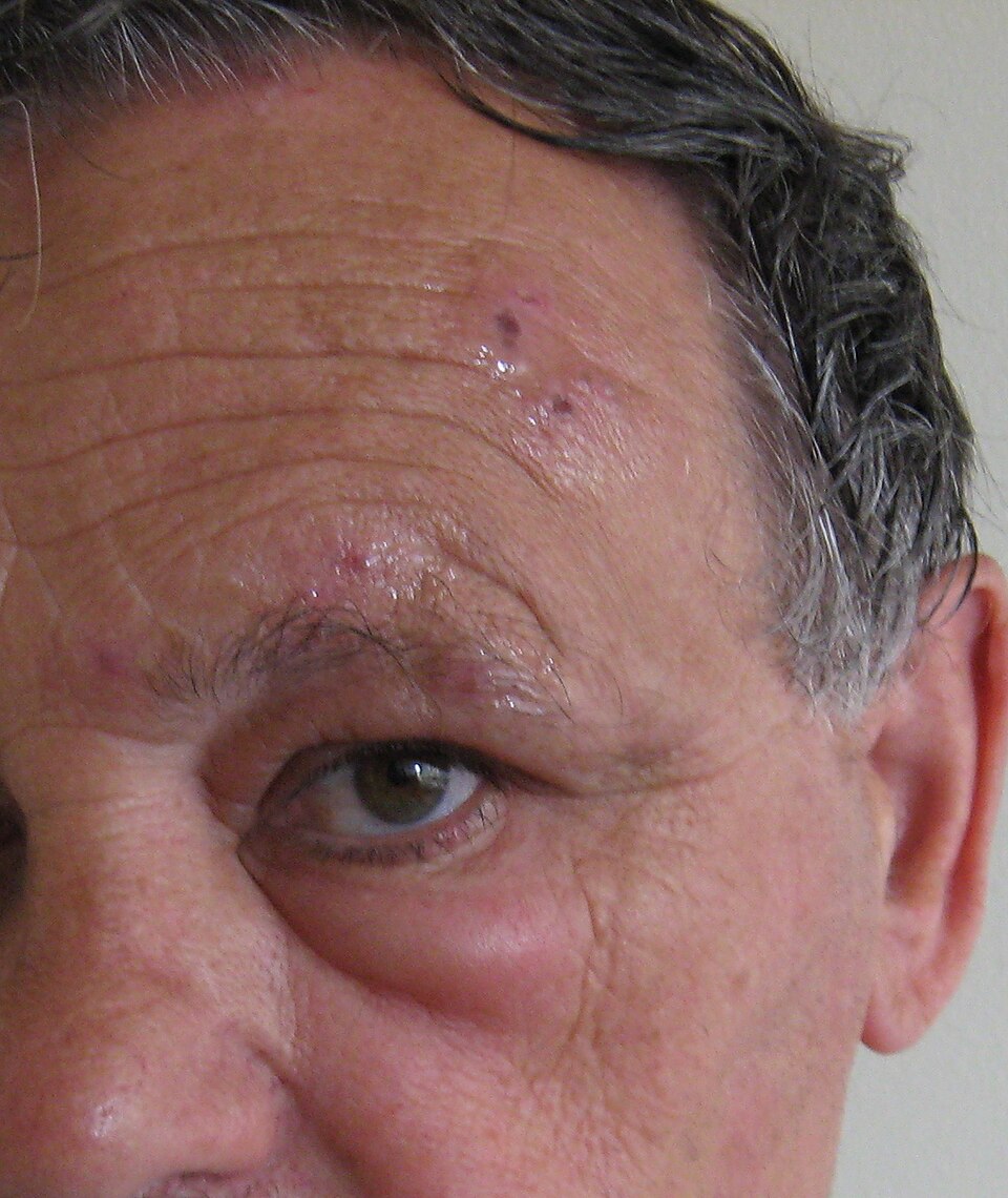 Herpes-Zóster (Cobreiro): Herpes zoster ophthalmicus.jpg