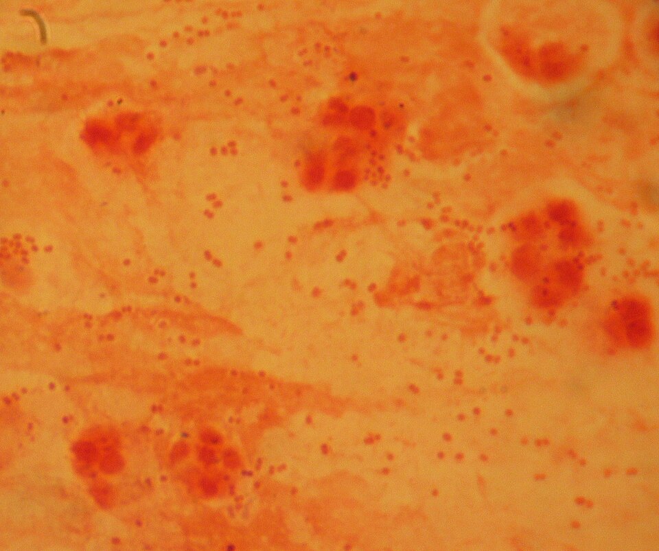 Haemophilus influenzae tipo b (Hib): Haemophilus influenzae Gram.JPG