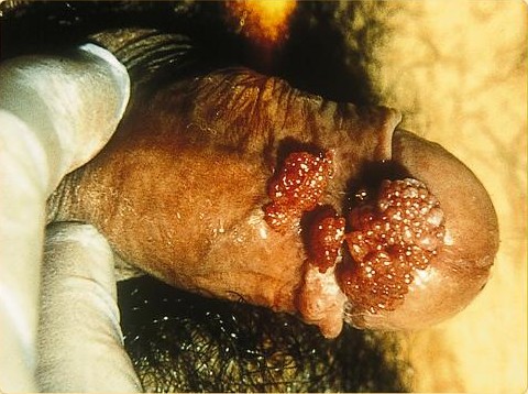 HPV (Papilomavírus Humano): SOA-Condylomata-acuminata-man.jpg