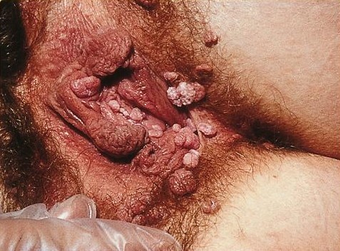 HPV (Papilomavírus Humano): SOA-Condylomata-acuminata-female.jpg