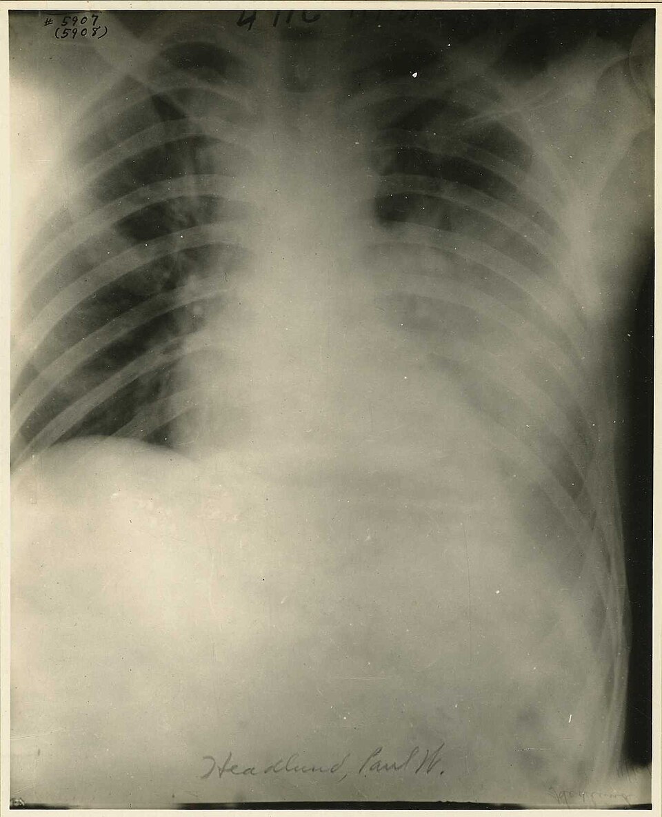 Influenza (Gripe): Chest X-ray of patient with influenza (Reeve 045377), National Museum of Health and Medicine.jpg