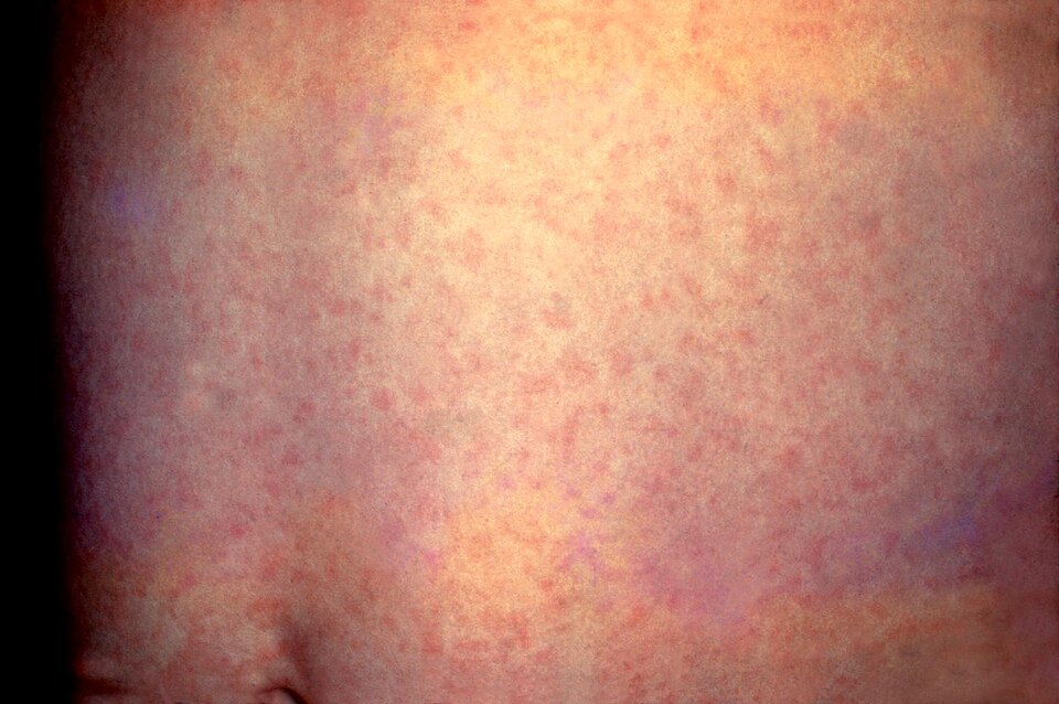 Rubéola: Rubella.jpg