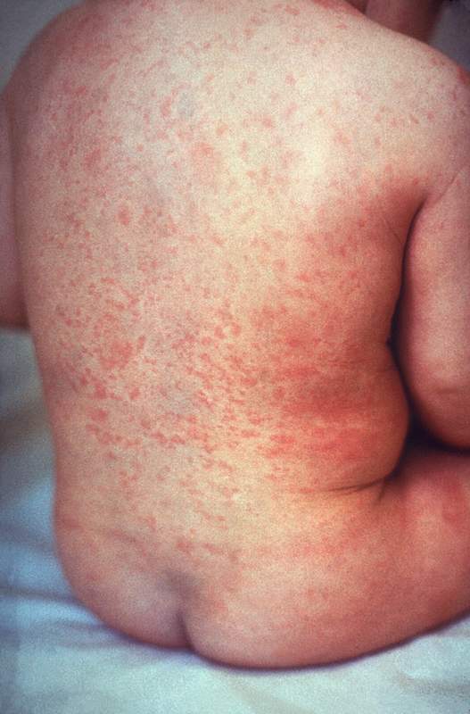 Rubéola: Rash of rubella on skin of child's back.JPG