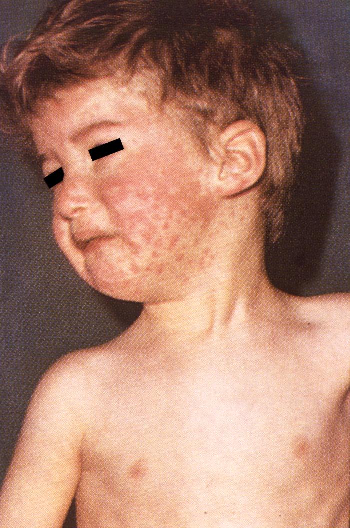 Sarampo: Boy with measles.jpg