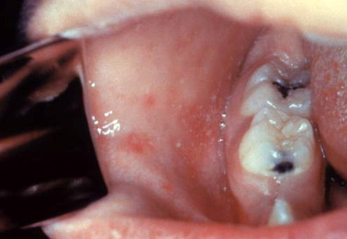 Sarampo: Koplik spots, measles 6111 lores.jpg