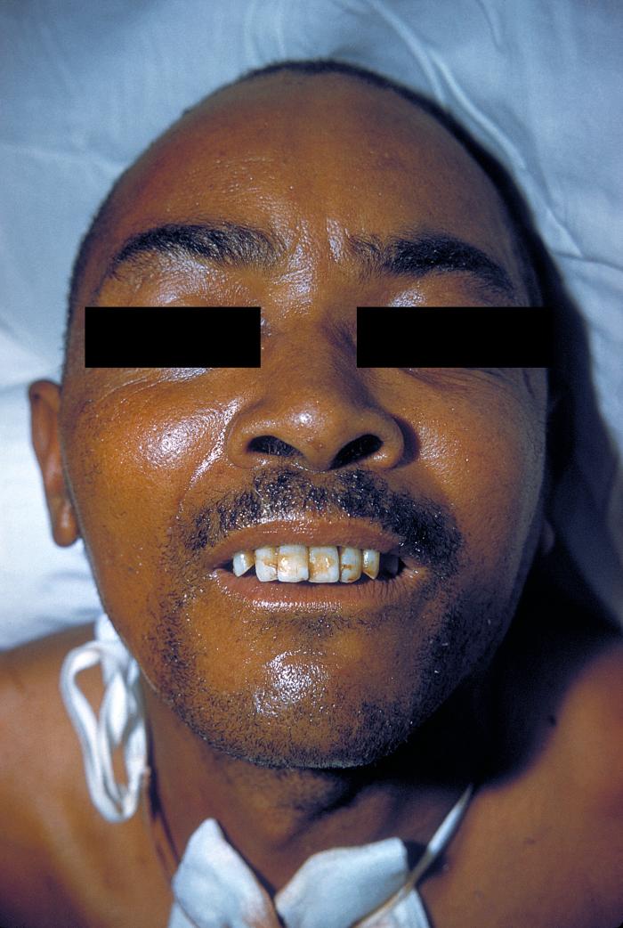 Tétano: Lock-jaw 2857.jpg