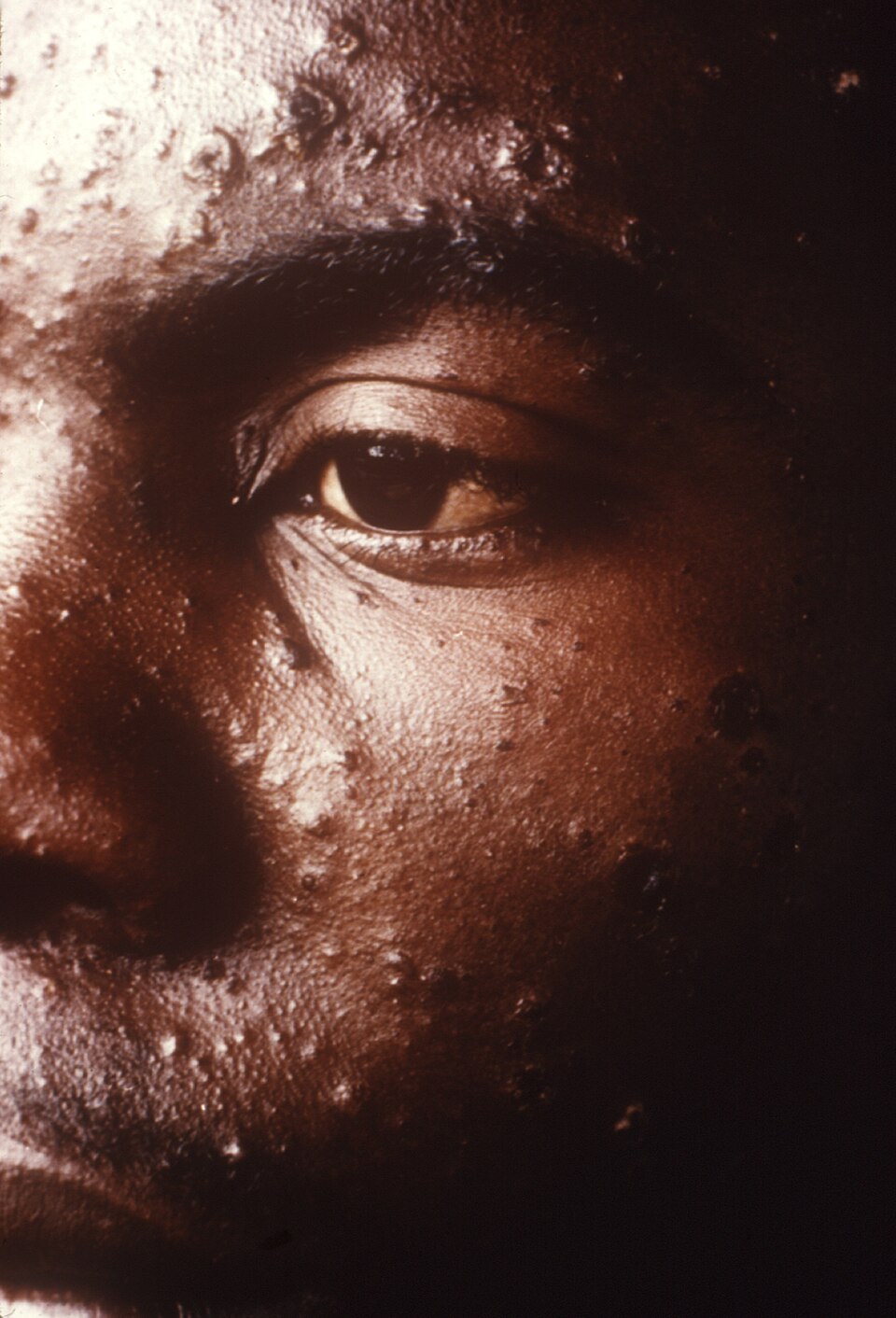 Varicela (Catapora): Chickenpox.jpg